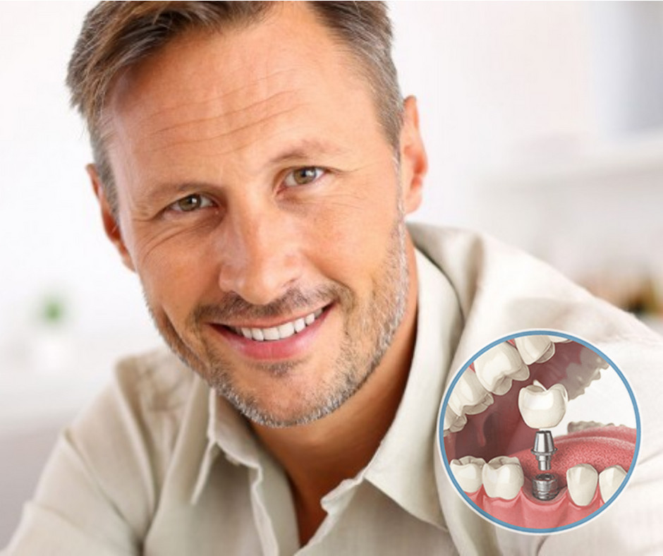 Smiling man with a diagram showing a single tooth dental implant and crown