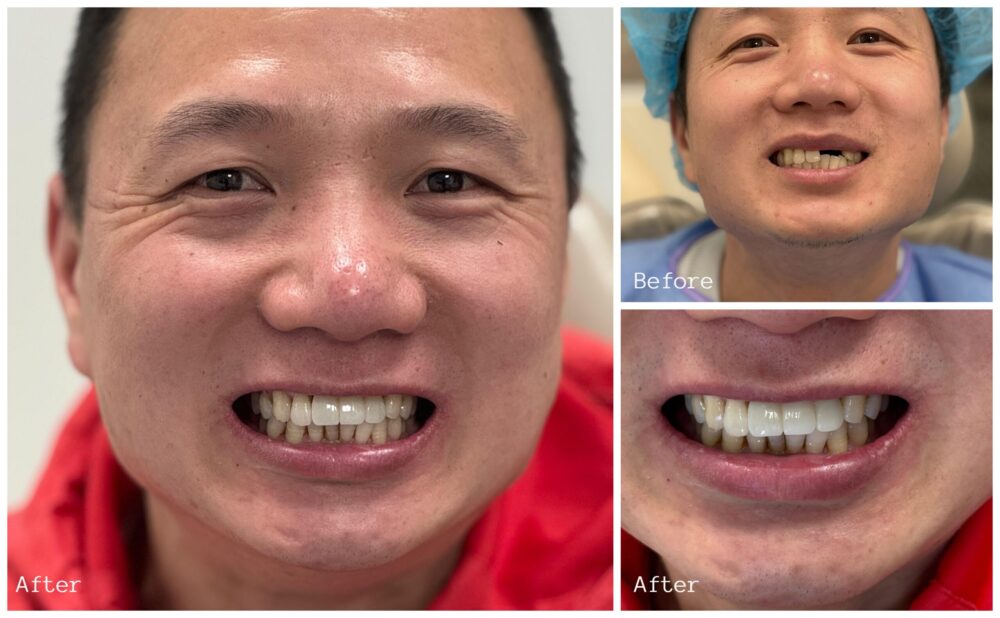 Before and after full smile restoration for a male patient