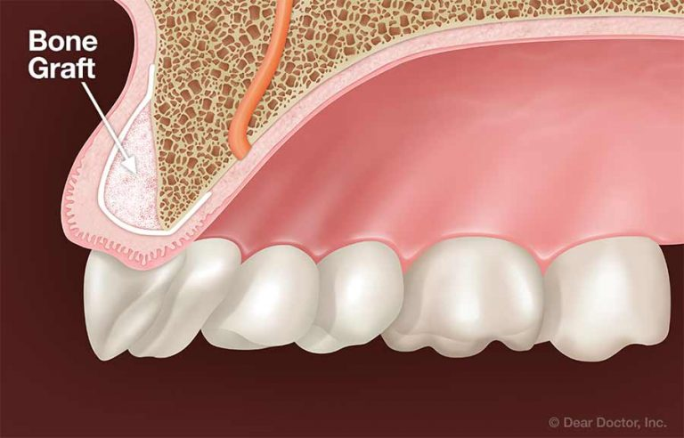 Illustration of a dental bone graft placed in the upper jaw