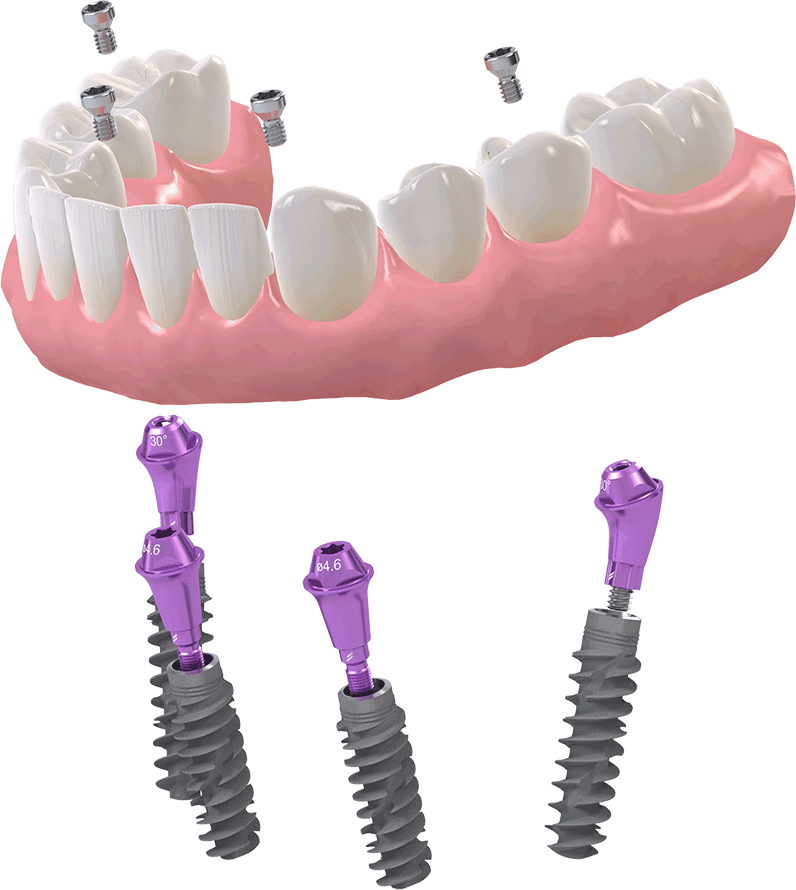 ProArch BLX All-on-4 dental implant system showing the full arch bridge and angled titanium implants