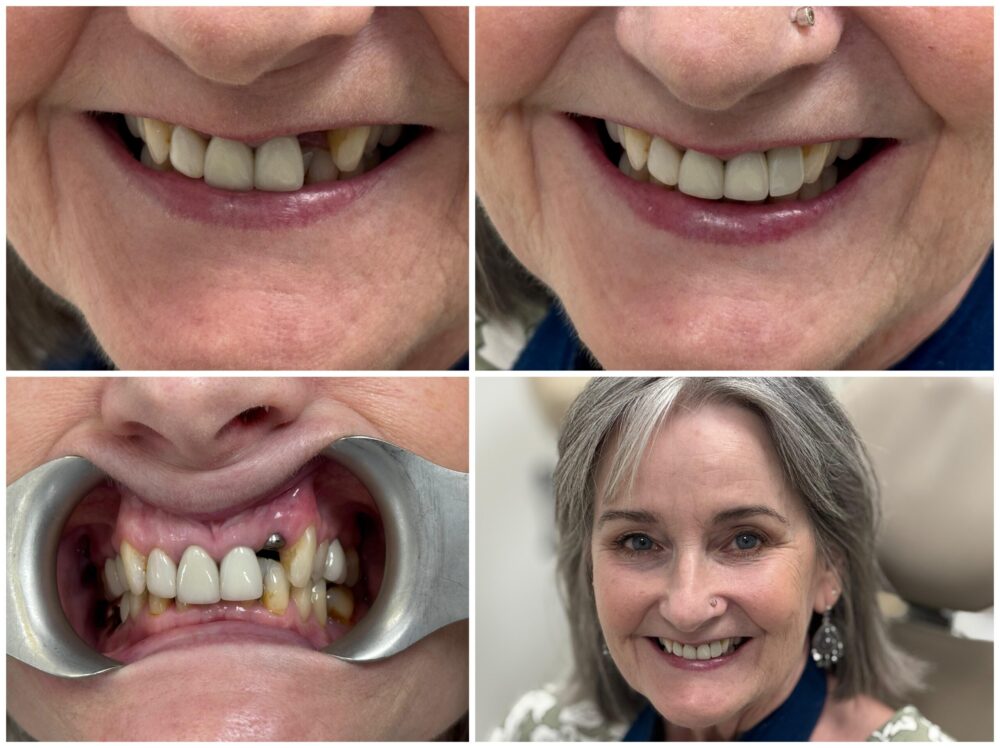 Before and after implant smile transformation for a female patient