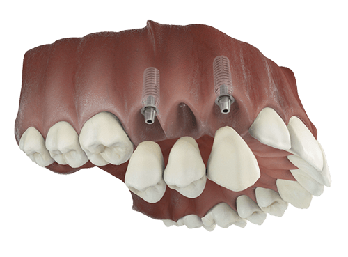 Diagram of two dental implants placed to support a bridge replacing multiple missing teeth
