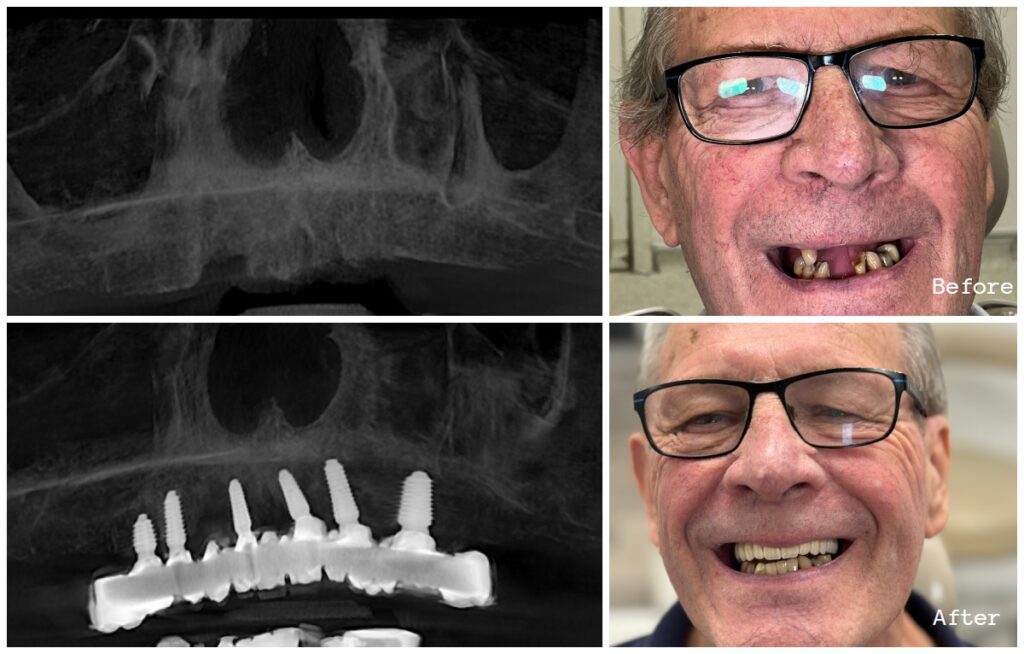 Before and after full-arch implant case with X-rays for an older male patient