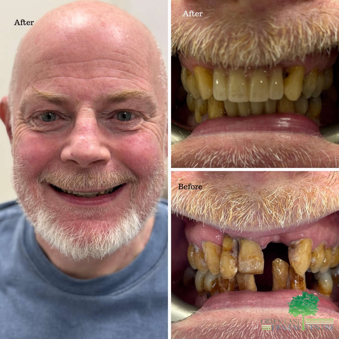 Dental implant before and after smile transformation at Green Lane Dental Centre