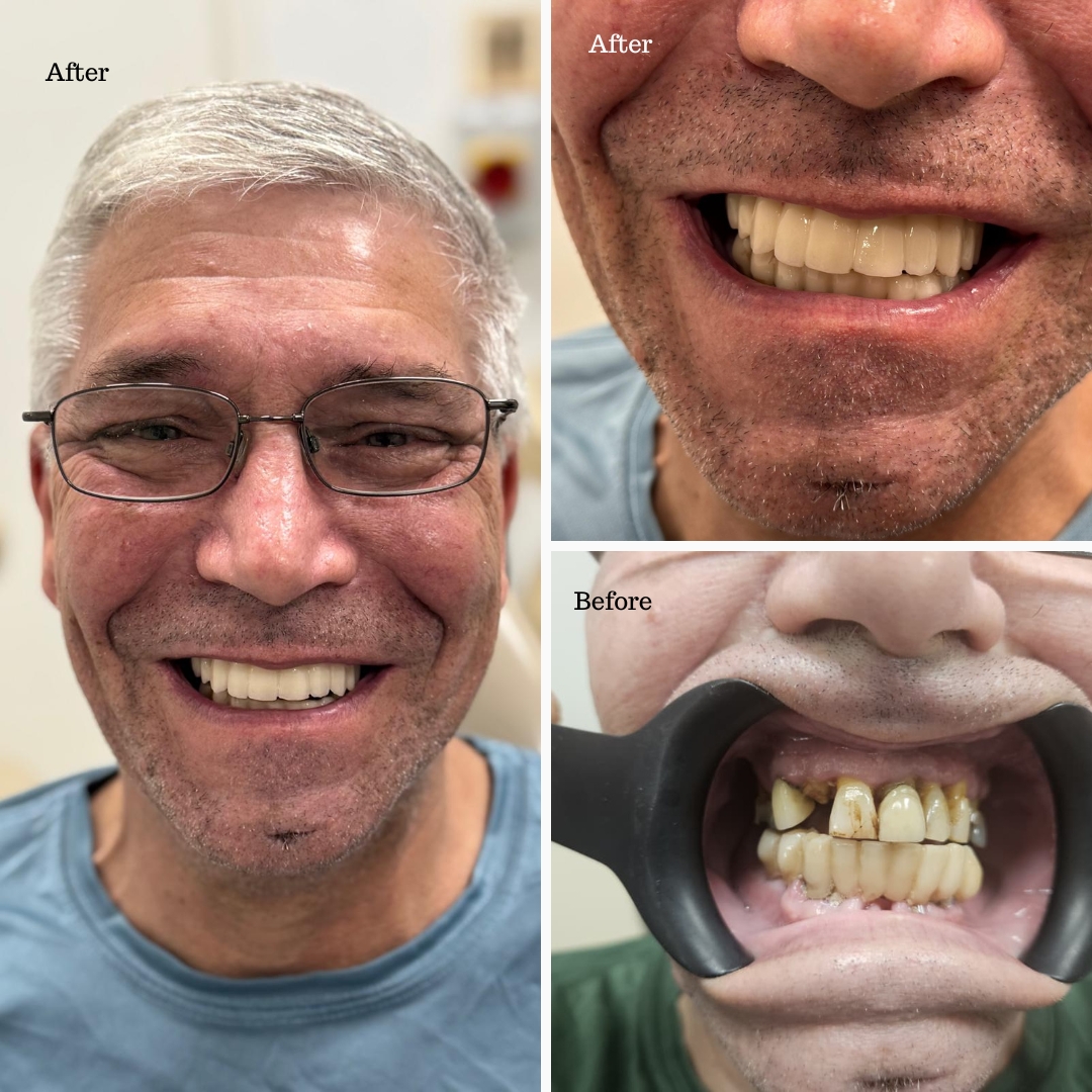 Before and after implant smile makeover for an older male patient