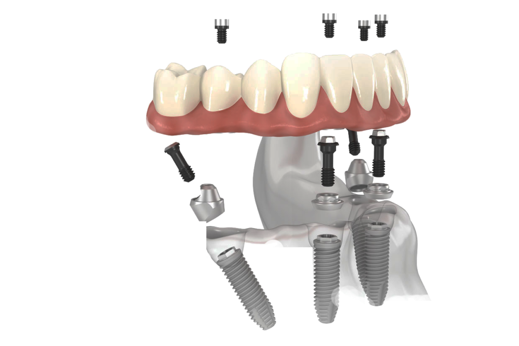 Diagram of an All-on-X full arch bridge supported by multiple titanium implants in the jaw