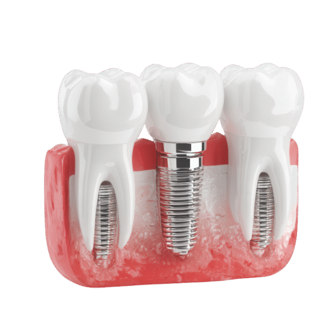 Implant supported bridge replacing multiple missing teeth