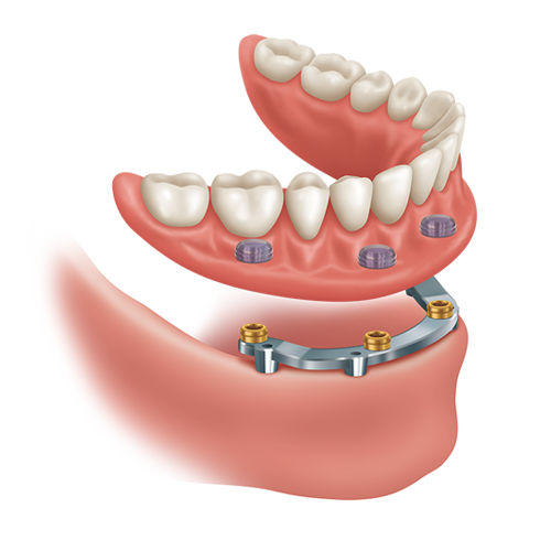 Diagram of a bar-retained implant denture clipping onto a metal bar over implants