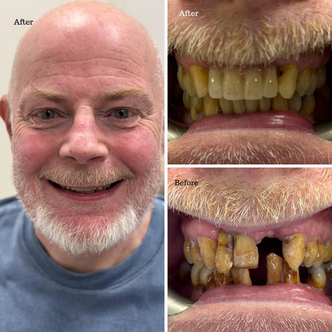 Before and after dental implant transformation for a bearded male patient