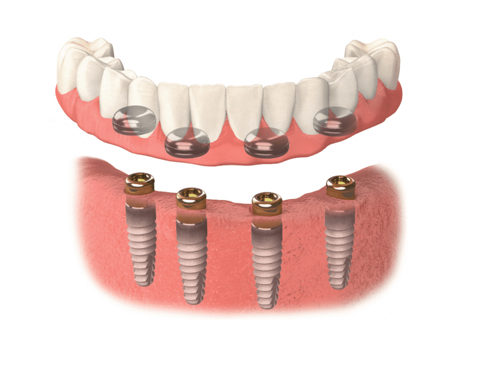 Diagram of a locator-retained overdenture snapping onto four dental implants