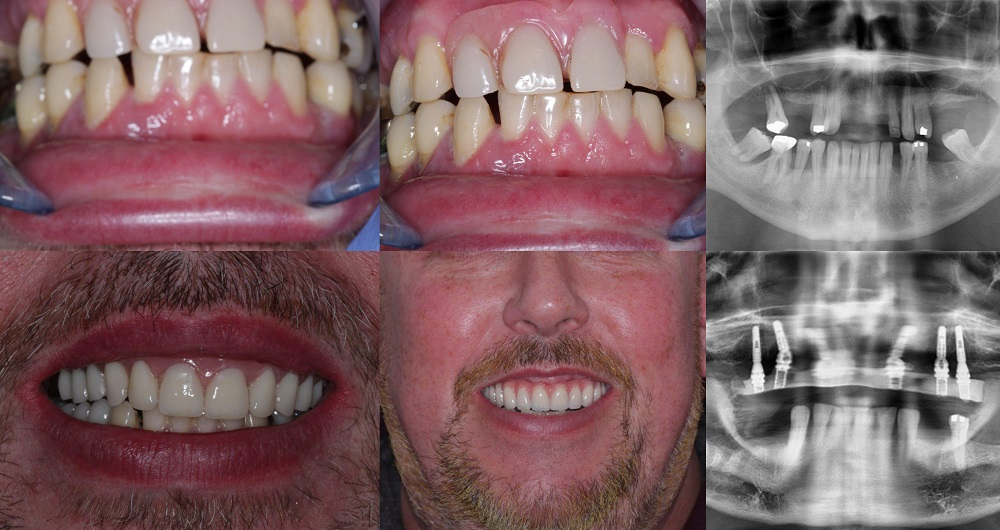 Before and after All-on-6 implants with same-day fixed bridge — clinical photos and X-rays