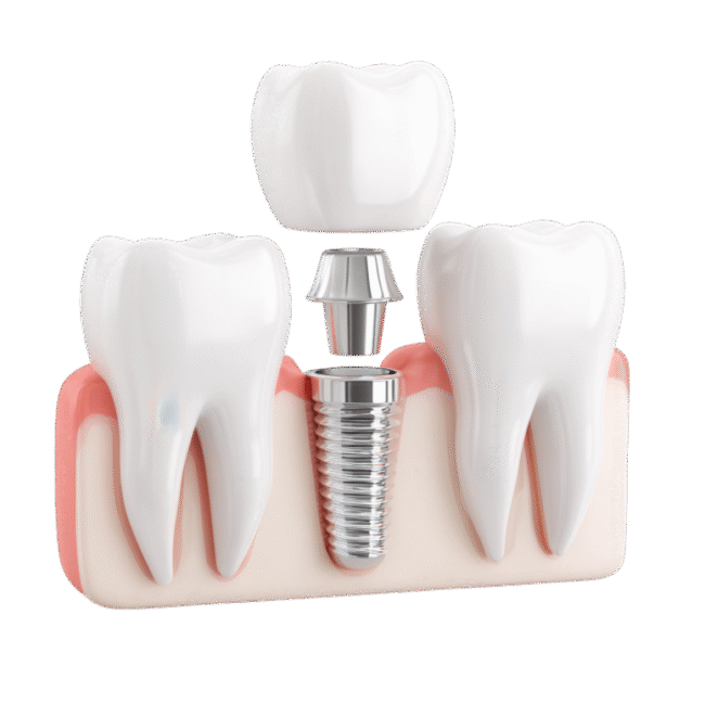 Single dental implant replacing one missing tooth