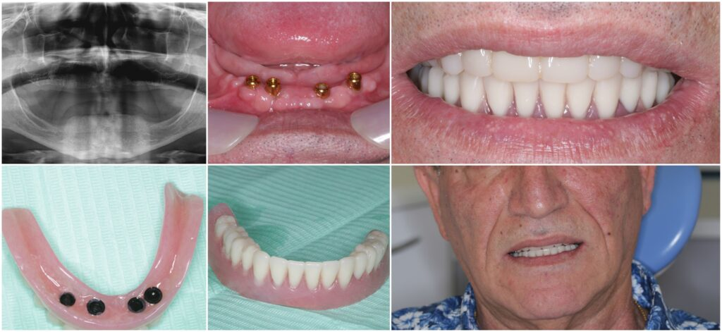 Before and after implant-supported lower denture — X-ray, implants placed, denture fitted and final smile
