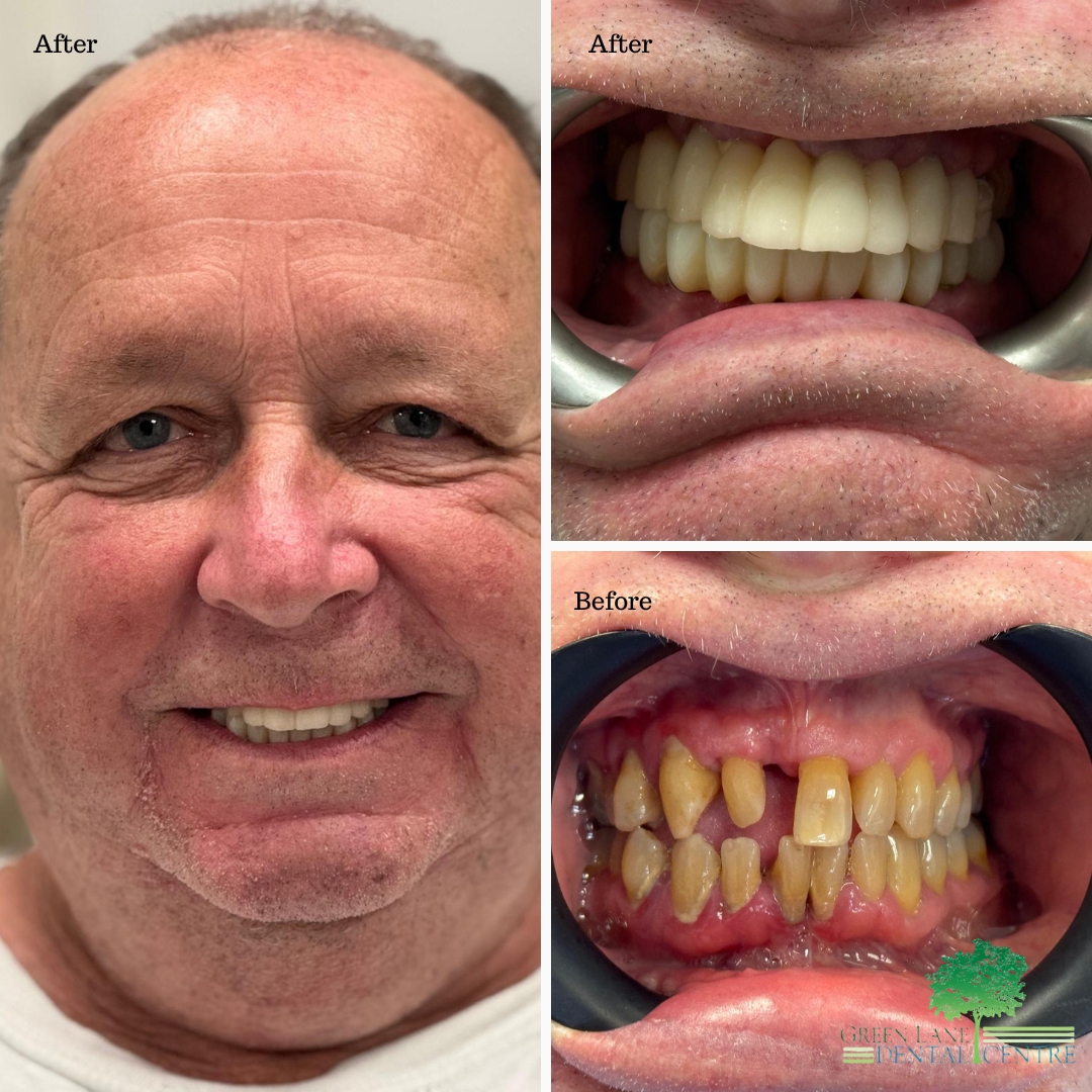 Dental implant before and after smile transformation at Green Lane Dental Centre