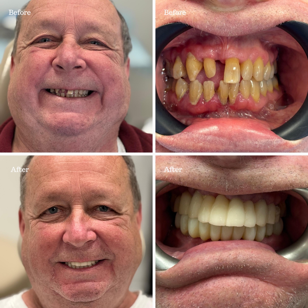Before and after full-arch fixed bridge for a male patient