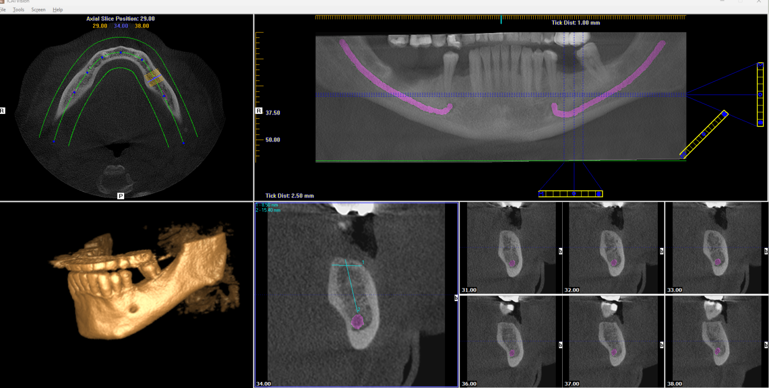 CBCT implant planning software showing axial, panoramic, 3D and cross-sectional views of a lower jaw with the nerve canal traced