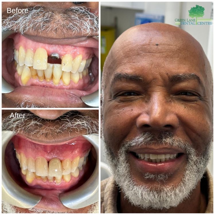 Before and after front tooth implant case for a male patient