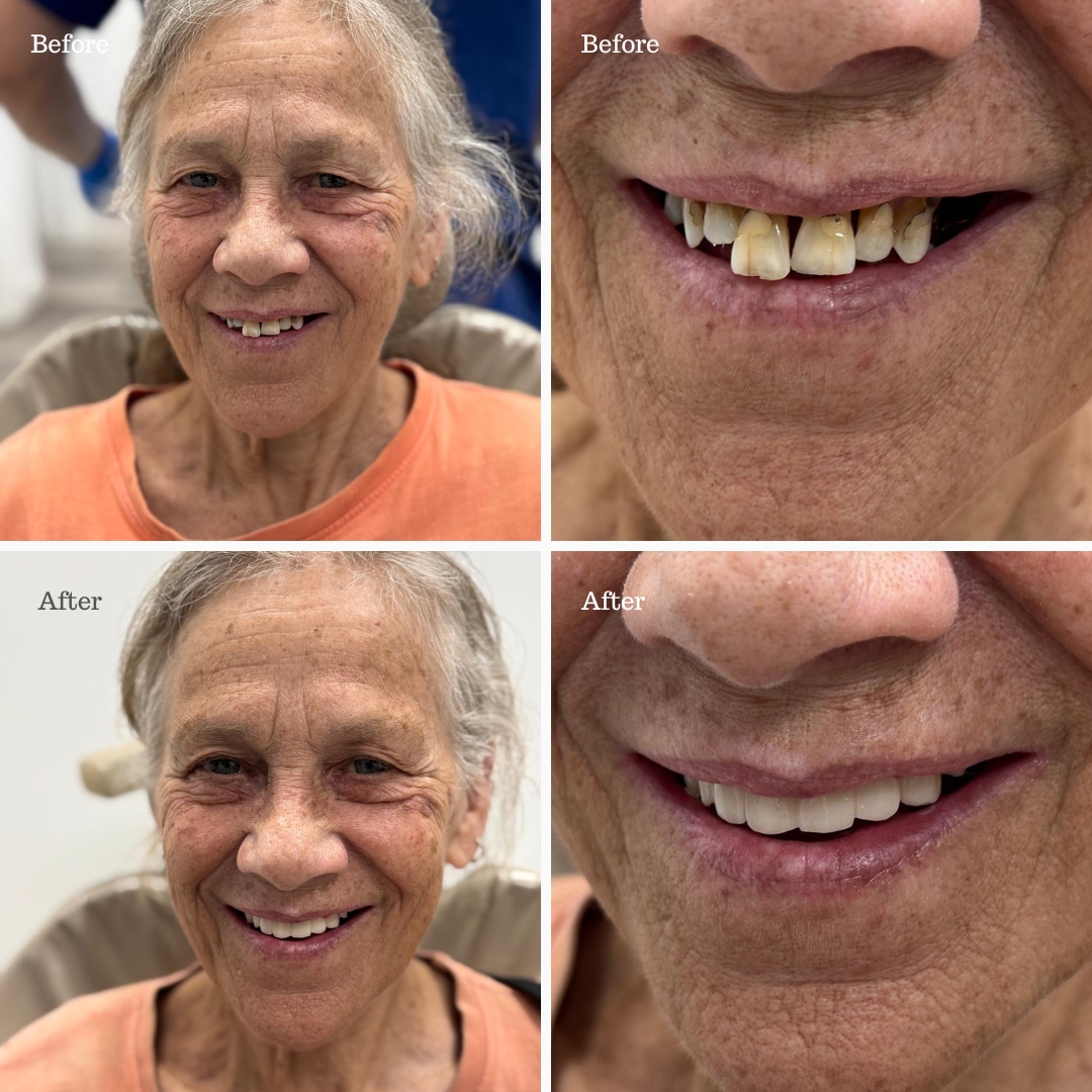 Before and after full-arch implant smile transformation for an older female patient