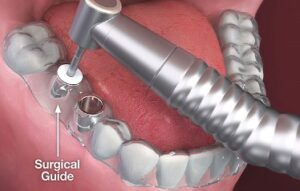 Illustration of a dental drill guided through a custom surgical guide during implant placement